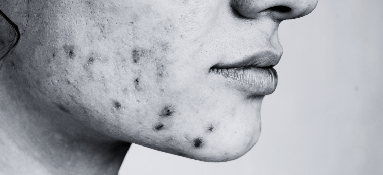 Acne & Oily Skin